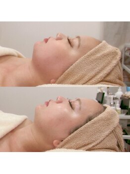 シュリー(Sriii)/インディバ×レモンボトル症例