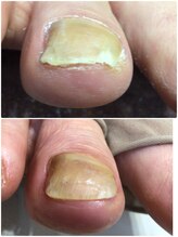 モアクリスタル(More Crystal)/巻き爪補正