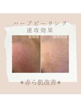 ビューティーサロン エー(A)/ハーブピーリング赤ら肌