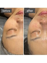 ロッタ エクリュ(Lotta ecru+)/REVI剥けないハーブピーリング