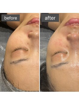 ロッタ エクリュ(Lotta ecru+)/REVI剥けないハーブピーリング