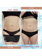 縁(en)/脂肪冷却2回