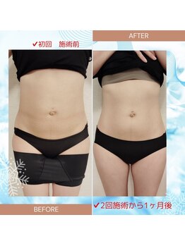 縁(en)/脂肪冷却2回