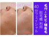 【顔面ムダ毛は滅】コスパ最大！顔面のムダ毛は脱毛機フェイシャル60分4400円