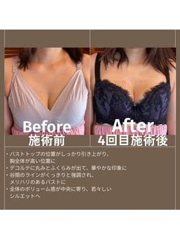 エミニナル(EMININAL)/【バストケア】ビフォーアフター