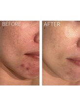 ココラーレ(cocorare)/剥離しないハーブピーリング