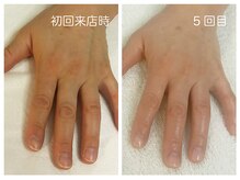 キレイテ 福岡天神店/40代/5回目【天神ハンドケア】