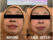 ラディアント(Radiant)/エンビロン　乳酸ピーリング