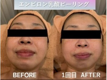 ラディアント(Radiant)/エンビロン 乳酸ピーリング