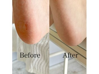 カルマ(Karma)/角質を除去しかかとつるぴかさん