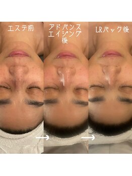 メナードフェイシャルサロン 丸の内ヒルズの写真/1回のケアで効果を実感したいあなたに!【アドバンス&小顔ケア+LRパック】急なイベントの前のお手入れにも♪