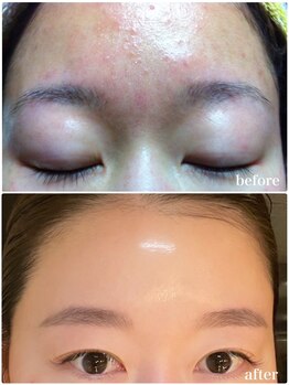 プリマジュール/ニキビケア