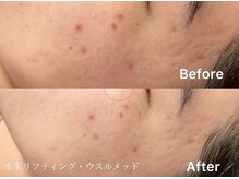 サロンヴェアリー 広尾(salon vary)/LDM＆ウルスメッド直後