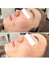 ニキビ研究所 町田店/毛穴から変わる！ハリツヤ肌へ！