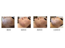 リツイート(ReTweet)/美肌髭脱毛