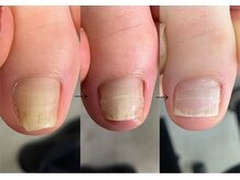 ロンディネ(Rondine)/巻き爪ケア5