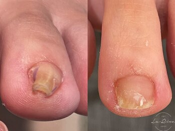 ラ リノ(La-Rino.)/巻き爪改善ケア