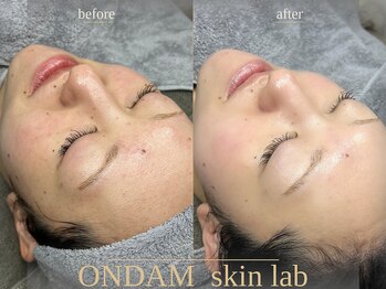 オンダム 表参道(ONDAM)/一度でもつやつやたまご肌に♪