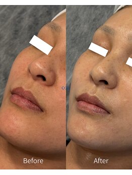 オン(on.)/《お客様症例》施術1回