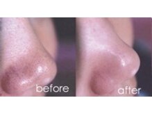 ドクター ヴィーナス/ガラス管２本使用の本格毛穴洗浄