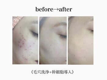 アルゴ 吹田千里山駅前店(ALGO)/【毛穴洗浄+幹細胞導入+脱毛】