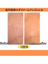 パルティノ 高崎店/毛穴洗浄・エクソソーム