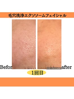 パルティノ 高崎店/毛穴洗浄・エクソソーム