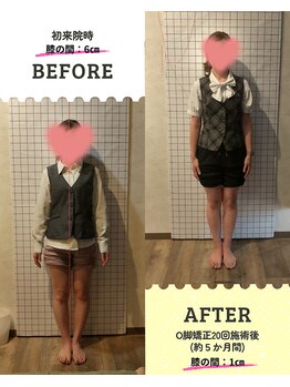 ライフファン鍼灸接骨院 みらい平(Life Fun鍼灸接骨院)/О脚矯正!!