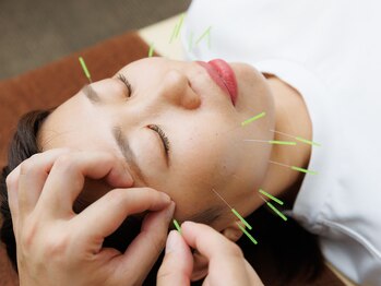 大宮ウィル鍼灸整骨院/顔鍼施術鍼灸小顔鍼リフトアップ