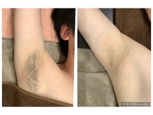 ラ ボーテ(La Beaute)/ワキ脱毛