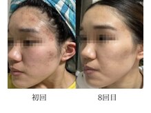 リツイート(ReTweet)/美肌光フェイシャル