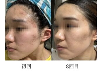 リツイート(ReTweet)/美肌光フェイシャル