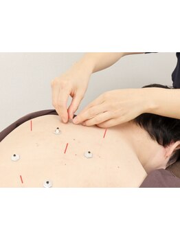 鍼灸施術を受けたい