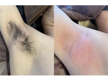 ビューメン(BYUMEN)/人気のワキ脱毛でワキ汗スッキリ