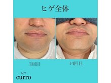 アクト クロ(ACT curro)/【ヒゲ全体】脱毛施術例