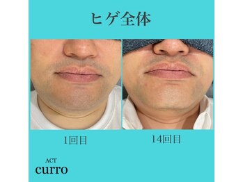 アクト クロ(ACT curro)/【ヒゲ全体】脱毛施術例