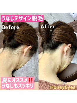ハニーアイズ(Honey Eyes)/うなじmix脱毛で後ろ姿スッキリ!