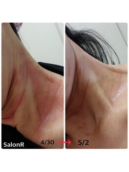 ルヴィショップ 京都駅前店(REVI SHOP)/NMNナノフェザーパウダー効果