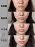 【小顔マシン】超音波でスッキリ小顔/リフトアップ毛穴・弾力改善 シングル
