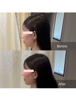 プライミー(PRIMY)/小顔矯正で横顔美人