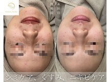 ベルフィーヌ 目黒店(BELFINE)/ハーブピーリング