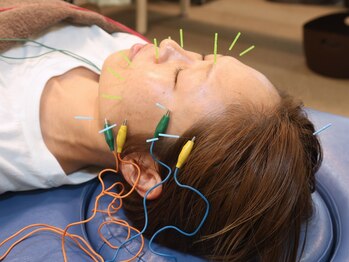 あらた鍼灸整骨院の写真/美容鍼はリフトアップ効果抜群★理想の小顔へ♪ハリや潤いを引き出し肌悩み改善◎【初回￥2980-】