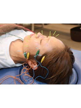 鍼灸施術を受けたい