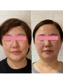 サロンドミジュ(Salon de 美jyu)/骨格・小顔矯正 T様 50代