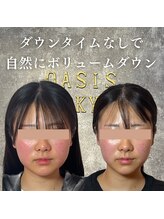 オアシス トウキョウ 川崎店(OASIS TOKYO)/OASIS式脂肪術４回