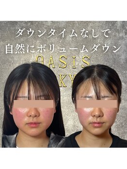 オアシス トウキョウ 川崎店(OASIS TOKYO)/OASIS式脂肪術４回