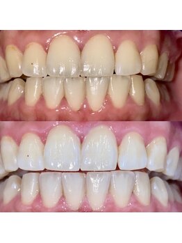 マイントゥー(mine too)/清潔感ある白い歯!!