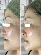 リムーブラボ 藤岡店(Remove Lab.)/大好評☆ハーブピーリング