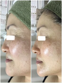 リムーブラボ 藤岡店(Remove Lab.)/大好評☆ハーブピーリング