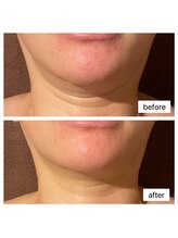 ウルト(ULT)/レモンボトルBeforeAfter